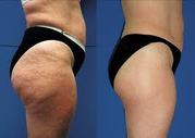 Fat loss & Cellulite Treatment 075 872 718 23 www.fatlossstudio.jimdo.com