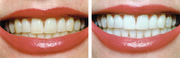 Professional Cosmetic Teeth Whitening
