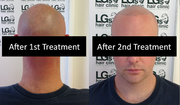 Baldness Cure In Birmingham