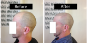 Bald Treatment In Birmingham