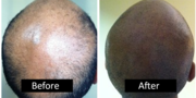 Receding Hairline Treatment In Birmingham
