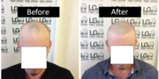 Charges For Hair Loss Treatment