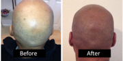 Scalp Micro Pigmentation Treatment In Birmingham