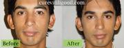 Cure Vitiligo curevitiligooil