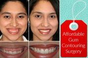 Experienced Cosmetic Dentist in Birmingham for Gum Contouring Surgery