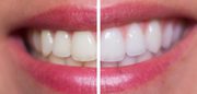 Best teeth whitening kits reviews