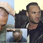 Hair Transplant in Liverpool