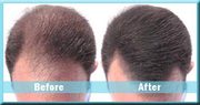 Hair Transplant in India