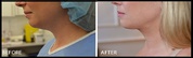 Get Vaser Liposuction Treatment from a Professional Surgeon