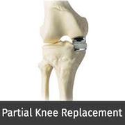 Total Cost of Partial Knee replacement Surgery in India