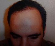 The leading Fue Hair Transplantation UK