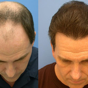 Enjoy Savings With Hair Transplant Surgery UK