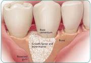 Bone Graft for Dental Implant: Understanding the Possibilities