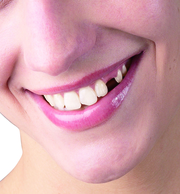 Get your Comfort Smile Back with Hungary Dental Implant