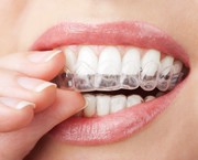 £1000 off on Invisalign Dental Treatment,  London