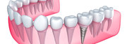 Tooth Implant in London | Hungary Dental Implant