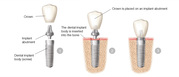 Dental Implants an Valuable Investment