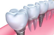 Dental Prosthesis in London