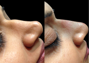 Get Non Surgical Nose Job Birmingham