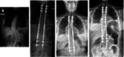 What is lumbar scoliosis | Consultant Spine Surgeon - Dr. Jwalant S Me