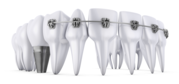 Find the Number One Lancaster Implant Dentist? Contact now!