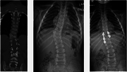 Congenital Scoliosis Spine Causes and Symptoms | Dr Jwalant Mehta | Me