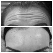  Anti-Wrinkle Treatment Watford