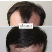 Hair Transplant in London | Fortes clinc