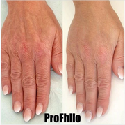 Profhilo treatment in Nottingham