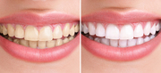 Want to get Ceramic Veneers at Delhi