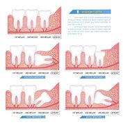 Get Wisdom Teeth Removal in Delhi | Smile Delhi