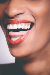 Teeth whitening Stoke-on-Trent