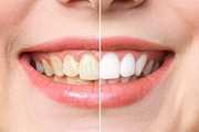 Cleaner Smile Teeth Whitening Kit