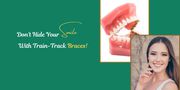 Don't Hide Your Smile With Train-Track Braces!