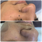 Skin tag removal clinic Goodmayes 